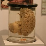The 3 Weirdest Brain Disorders?