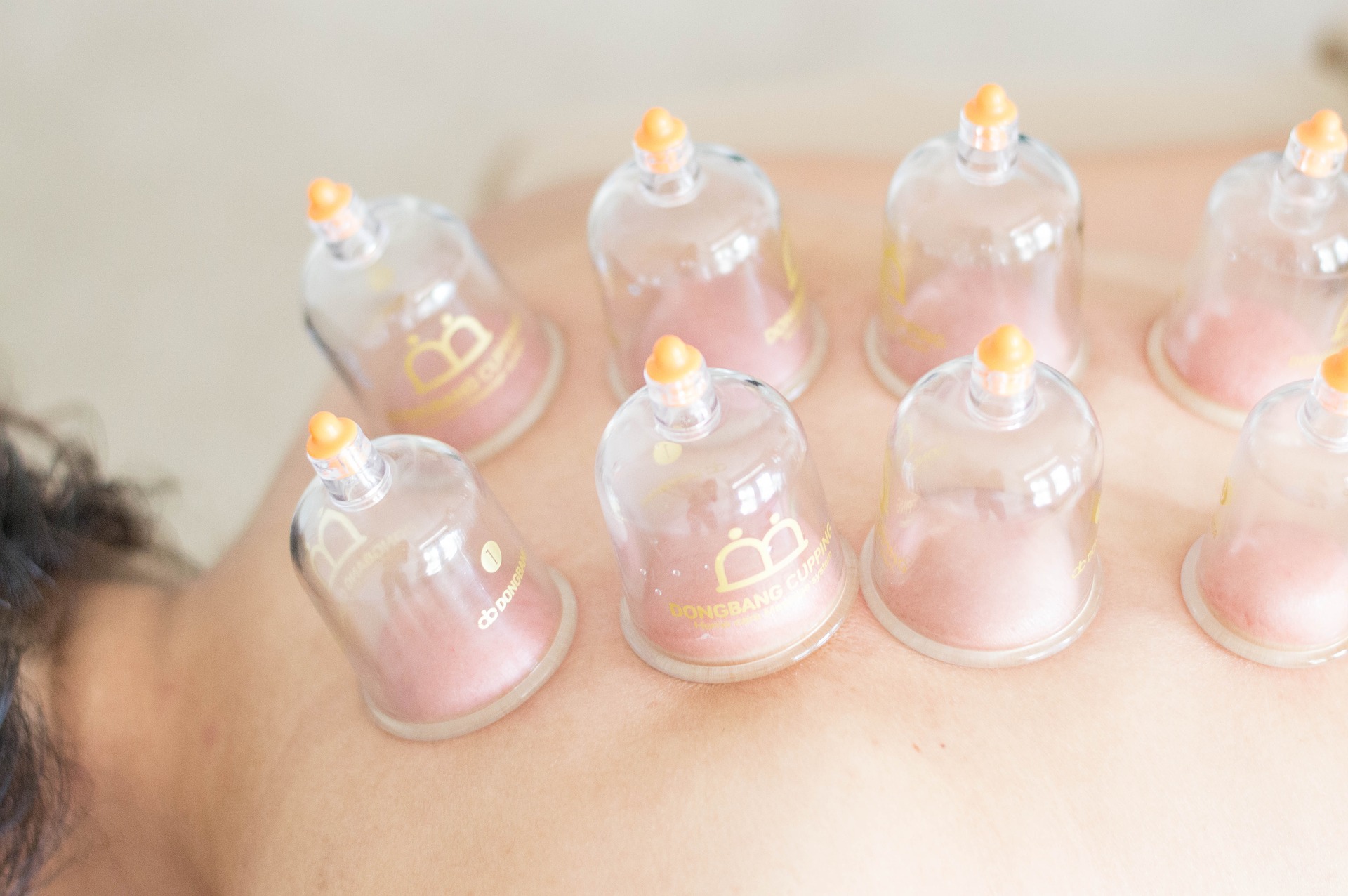 cupping therapy mental health